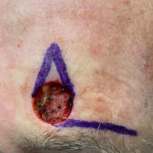 Surgical wound on forehead after complete skin cancer removal, margins marked in violet ink