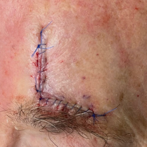 Forehead wound closed with a sutured flap immediately after reconstructive surgery