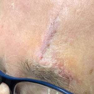Healed forehead one week after surgery with a faint scar
